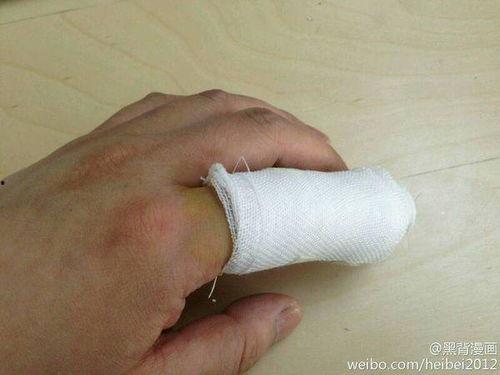 手受伤的图片,手部受伤急救与康复指南